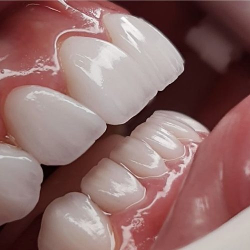 Dental Veneers: A Perfect Smile Solution